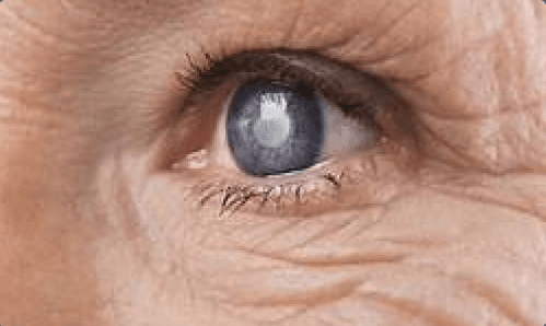 Glaucoma: sintomas, tratamentos e como prevenir a perda de visão